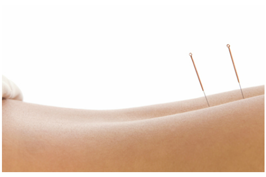 Acupuncture